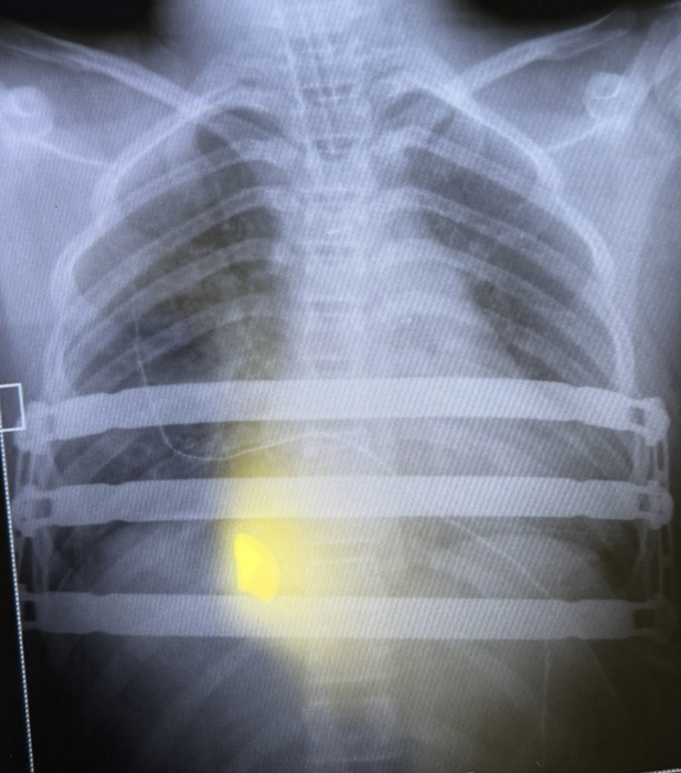 맥마혼 박사가 지난 6월 팩투스(Pectus) 수술을 집도 한 후 촬영한 흉부 X-ray 영상 이미지.