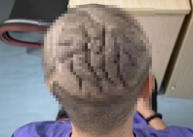 두피가 점점 딱딱해지는 희뤼 질환을 앓은 중국 20대 남성. 사진=SCMP