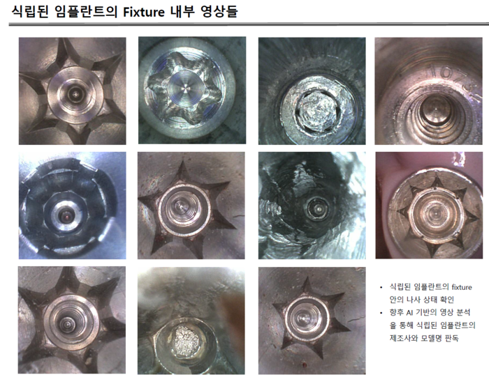 빅스캔 EndoSight 구강용카메라 ES-160K를 사용한 임상자료.