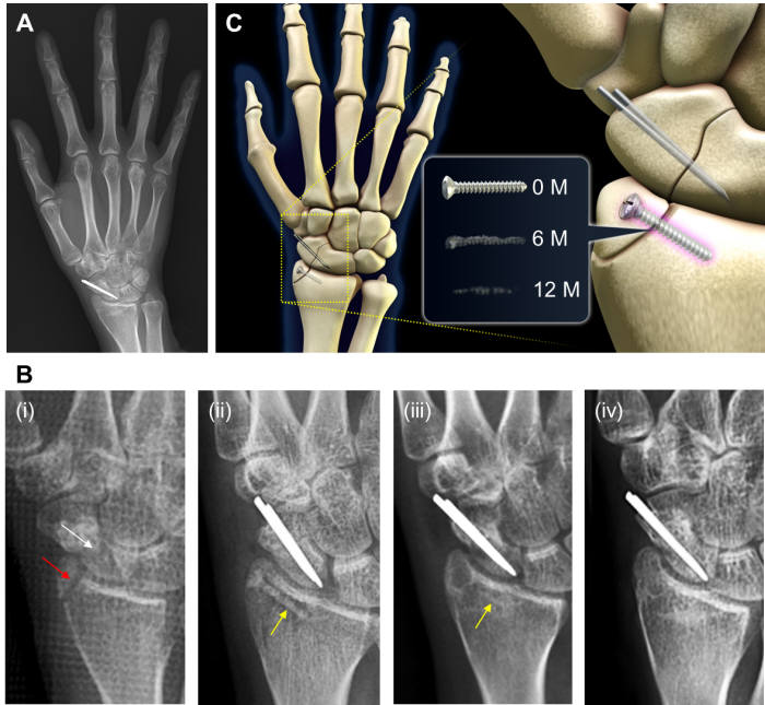 마그네슘 이식 1년 후, 완전히 녹으면서 뼈가 치유된 임상결과이다. (A) 요골 골절에 이식한 마그네슘합금 임플란트(MI)와 주상골 골절 부위에 스테인레스 임플란트(SI)를 이식 후, 1년 후 환자의 왼쪽 X-ray 사진이다. (B) 시술 경과에 따른 X-ray 사진을 나타낸다. (i) 시술 전 요골 골절과 주상골 골절 (ii) 시술 직후 요골 골절에 식립한 MI (노란색 화살표)와 주상골 골절부에 이식된 SI, (iii) 시술 6개월 후 요골 골절에 이식된 MI와 주상골 골절부에 식립한 SI, (iv) 시술 12개월 후 경과. (C) 시술 경과에 따른 MI의 변화를 설명하는 모식도. 빨간색 화살표는 요골 골절, 백색 화살표는 주상골 골절, 노란색 화살표는 MI를 나타낸다.