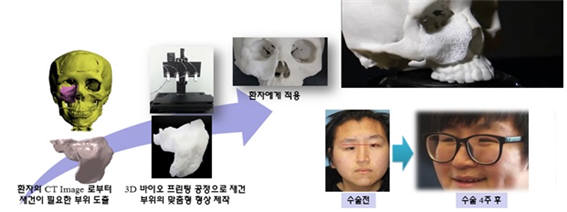 서울성모병원 환자맞춤형 안면윤곽재건 수술 사례