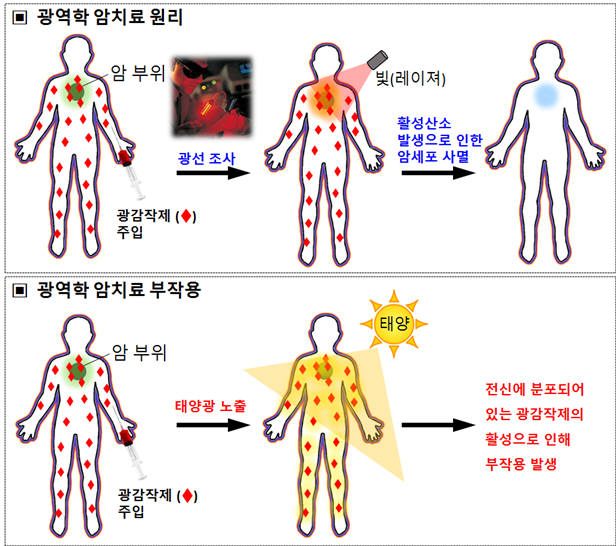 광역학 치료의 원리와 부작용. 광역학치료는 빛(光)에 화학적 반응을 일으키는 광감작제를 암부위에 주입해 빛으로 종양만 특이적으로 괴사시키는 치료법이다. 하지만 기존 광감작제는 태양광에도 반응하여 부작용을 일으키므로 시술 후 몇 주간 태양광을 보지 말아야하는 불편함이 있었다.