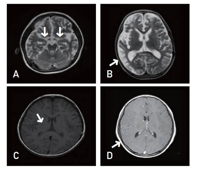 모야모야병 환자 MRI 영상(자료: 서울대 어린이병원)