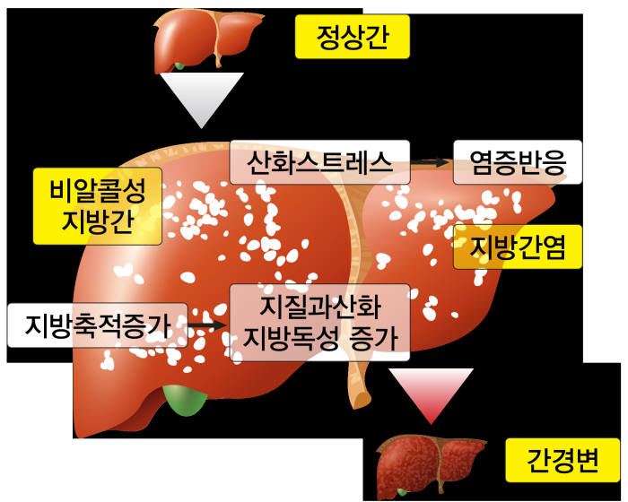 비알콜성지방간 생성 경로