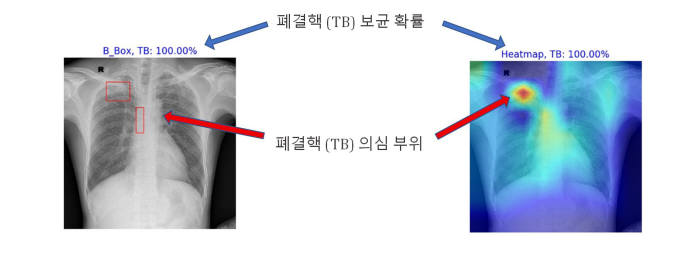 AI로폐결핵 의심, 보균 부분을 판독한 장면.(자료: 래디센)