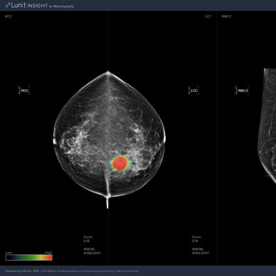 유방촬영술을 위한 루닛 인사이트 (Lunit INSIGHT for Mammography)