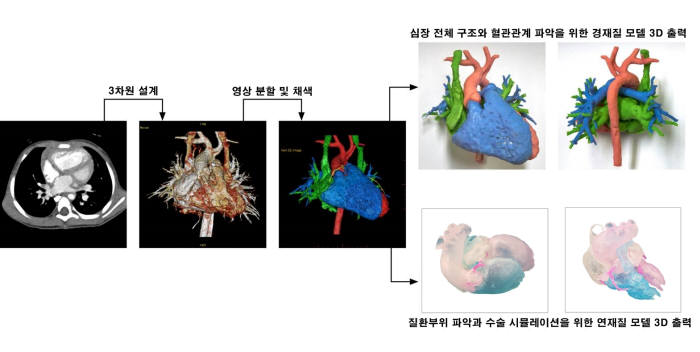 3D프린팅 심장기형질환 수술 시뮬레이션 과정