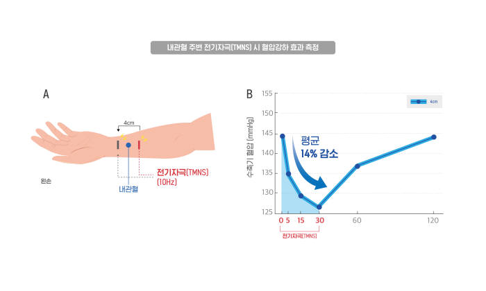 내관혈 주변 경피신경 전기자극(TMNS) 시 혈압강하 효과