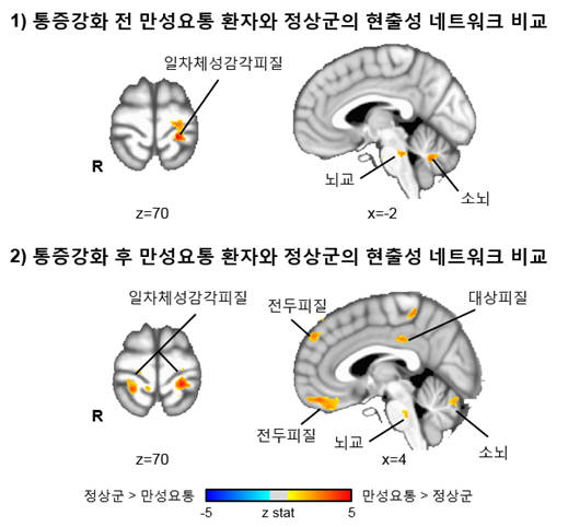 만성요통 환자와 정상군 간 현출성 네트워크 비교