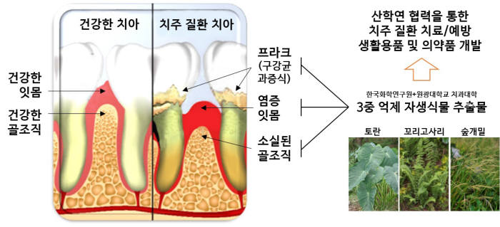 천연물을 기반으로 한 치주염치료 및 예방 기술 개요