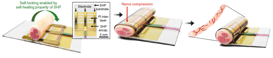 연구팀이 개발한 인공전자신경외피는 간단한 방식으로 고정할 수 있고, 수술 당시 약간의 눌림은 있지만 일주일 후 신경 압박 없이 완전히 신경막이 원형으로 회복된 모습을 확인할 수 있다.