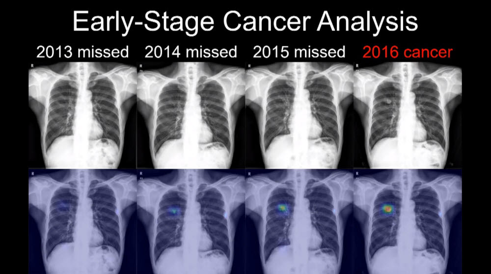 한 폐암 환자의 연도별 엑스레이 영상(아래는 AI 판독으로 포착한 병변). 이 환자는 2013년부터 2015년까지 정상 소견을 받은 뒤 2016년 확진 판정을 받았다. AI로 판독한 결과 2013년부터 병변이 포착됐다. 발표 영상 캡처