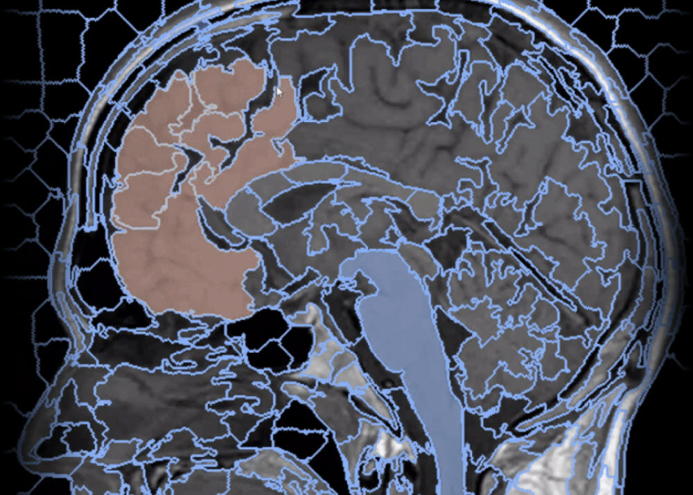 재이랩스가 개발한 메디라벨을 통해 라벨링한 뇌 CT 이미지. (사진=재이랩스)