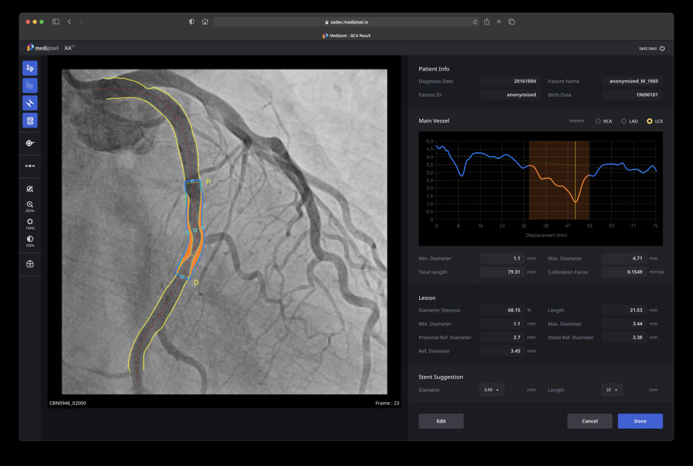 Medipixel XA 실행화면. 혈관을 자동으로 찾아주고(노란색) 막히거나 좁아진 상태를 그림(주황색)으로 보여준다. 또한 부위에 맞는 적합한 스텐트(파란색)도 제안해 준다. (사진=메디픽셀)