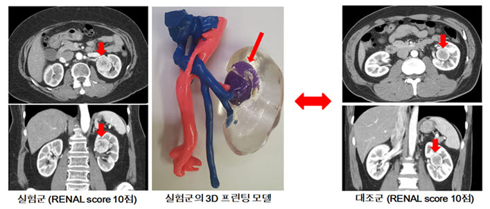 실험군(수술에 3D 프린팅 모델 활용)과 대조군의 수술 전 컴퓨터 단층촬영(CT) 사진 비교 (사진=분당서울대병원)