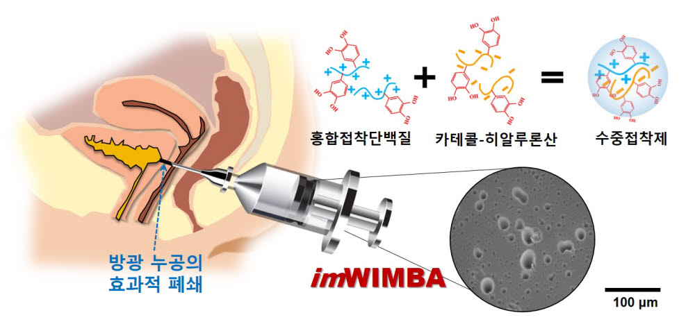 방광 누공 수중 접착제 이미지