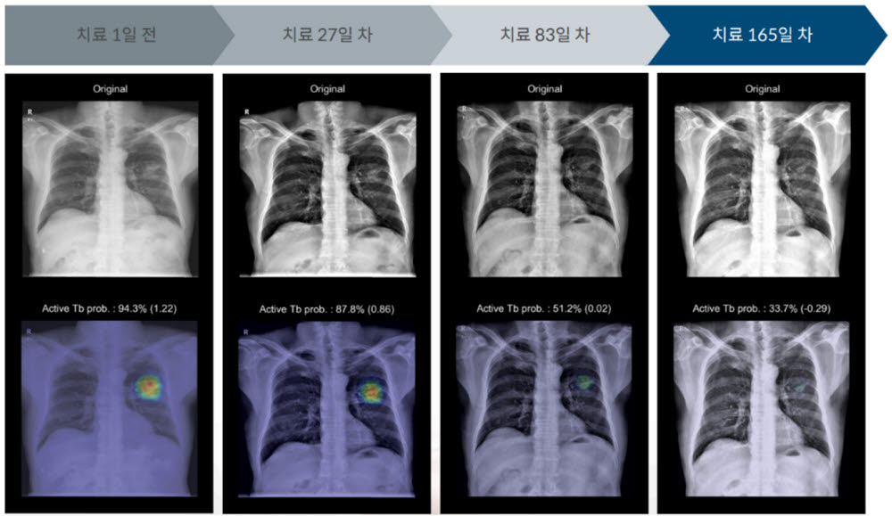 메디컬아이피 폐질환 모니터링 AI 솔루션 티셉(TiSepX) TB를 통해 폐결핵 치료 경과를 정량화해 확인할 수 있다. (사진=메디컬아이피)