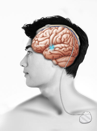 뇌심부자극술로 자극용 전극을 삽입한 모식도 (사진=서울대병원)