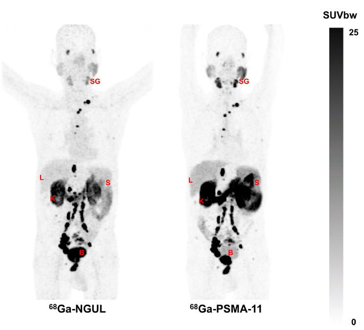 전이 전립선암 환자에게 PSMA-NGUL을 주입한 경우(왼쪽)와 PSMA-11을 주입한 경우(오른쪽)의 PET/CT 영상. 좌측 PSMA-NGUL의 경우 전립선암의 원발병소 (전립선), 임파절 전이병소, 뼈전이 병소가 뚜렷하고, 다른 장기들이 훨씬 흐리게 보여 보다 명확하게 진단할 수 있다. (사진=서울대병원)