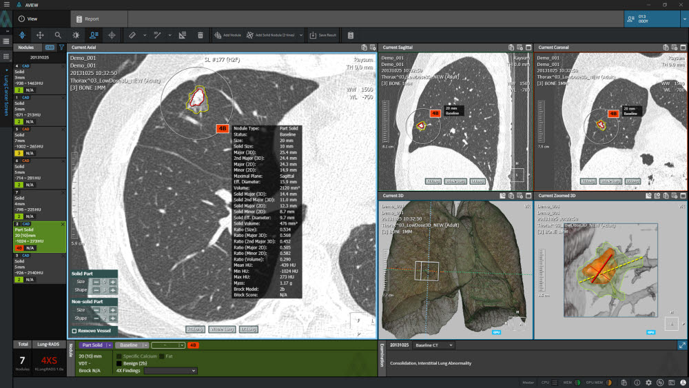 코어라인소프트 AI 폐암검진 솔루션 AVIEW LCS 화면 (사진=코어라인소프트)