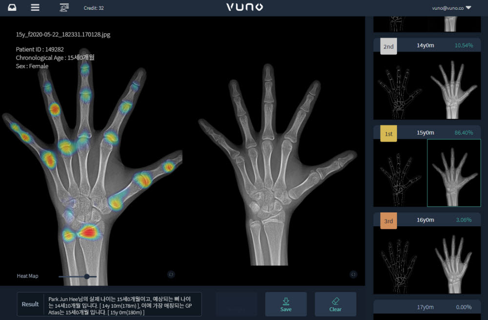 인공지능 기반 골연령 판독 보조 솔루션 뷰노메드 본에이지 (사진=뷰노)