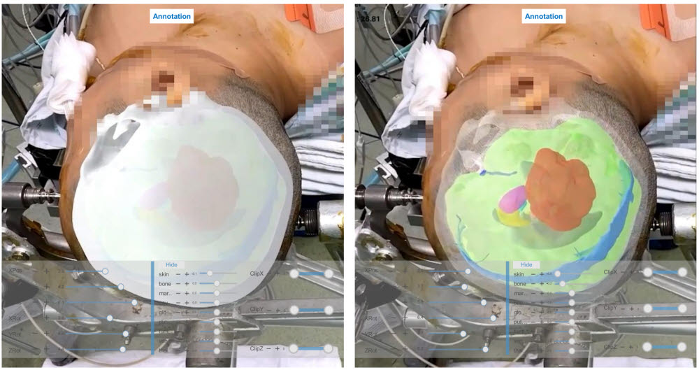 실제 MEDIP PRO AR을 활용해 증강현실로 구현된 환자의 수술 부위 (사진=메디컬아이피)