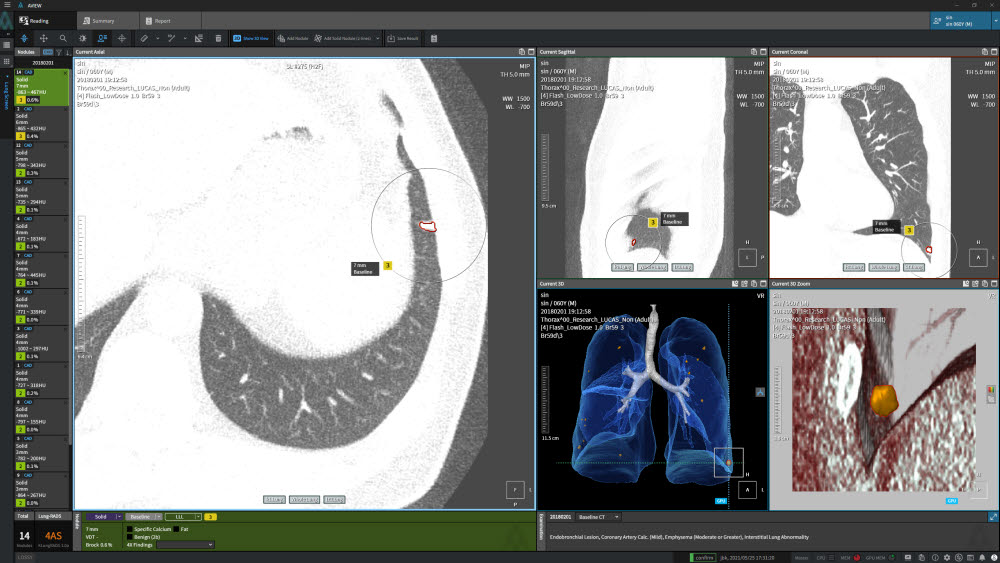 코어라인소프트 AI 흉부진단 솔루션 AVIEW LCS 진단 화면. (사진=코어라인소프트)