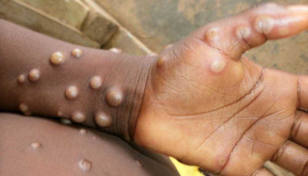 Monkey smallpox is characterized by blistering after a fever.  The rash progresses in the order of blisters, pus and scabs.  (Source: CDC, USA)