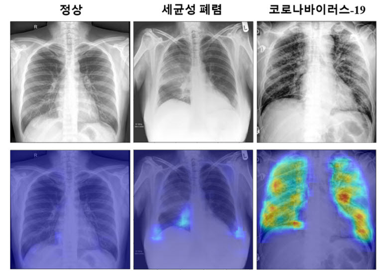 예종철 교수팀의 알고리즘으로 얻은 코로나19 확률 분포 지도. 병변 의심 영역이 표시된다.