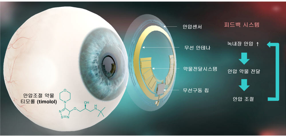 녹내장 환자의 안압 모니터링 및 안압 조절 약물 전달 피드백 시스템 모식도