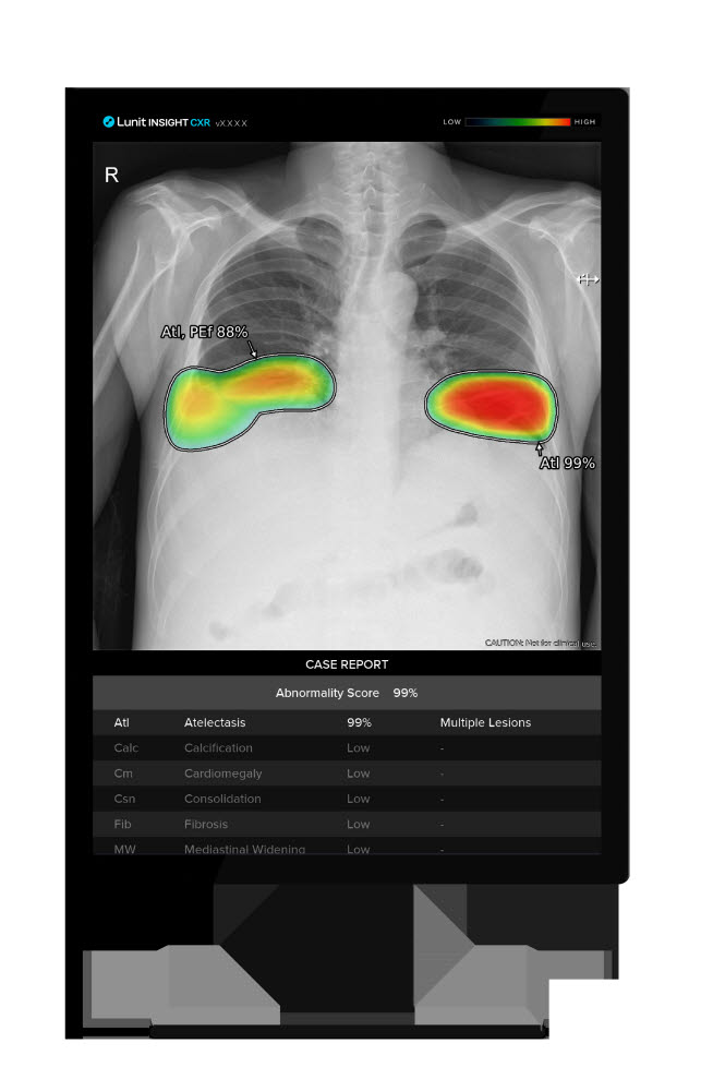 루닛 흉부 엑스레이 AI 영상분석 솔루션 루닛 인사이트 CXR (루닛 제공)